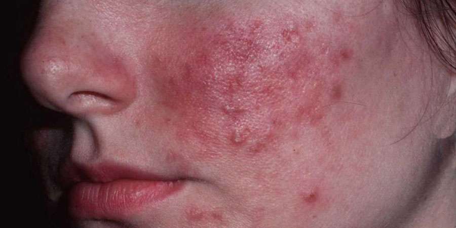 Gül Hastalığı (Rozasea) Nedir?