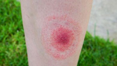 Lyme Hastalığı Nedir? Belirtileri, Tedavisi ve Korunma Yolları