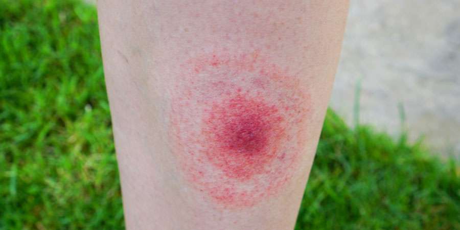 Lyme Hastalığı Nedir? Belirtileri, Tedavisi ve Korunma Yolları