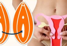 Labioplasti Nedir? Pubis Estetiği ve Vajina Daraltma ile İlgili Her Şey